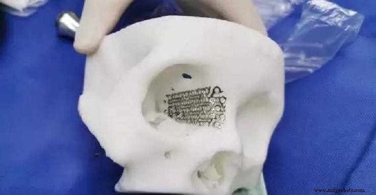 Las aleaciones de titanio revolucionan la reparación de fracturas orbitarias