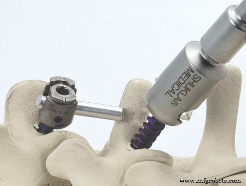 Cómo Shukla Medical Usa la Impresión 3D para Entregar Herramientas Quirúrgicas Más Rápido