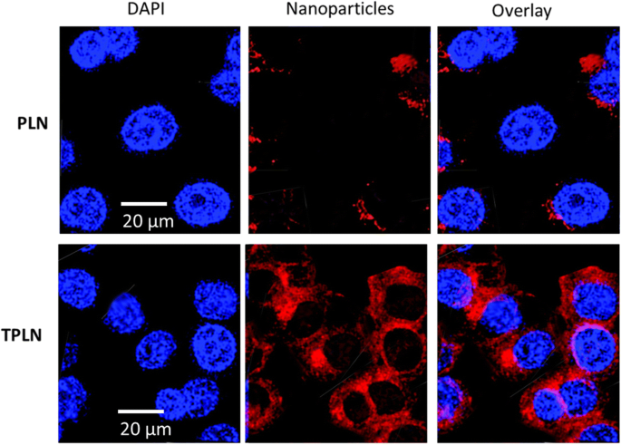 Nanopartículas Lipídicas Dirigidas Funcionalizadas con Transferrina Mejoran Eficacia Paclitaxel en Células Leucemia