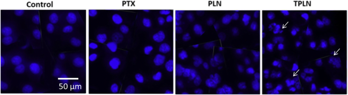 Nanopartículas Lipídicas Dirigidas Funcionalizadas con Transferrina Mejoran Eficacia Paclitaxel en Células Leucemia